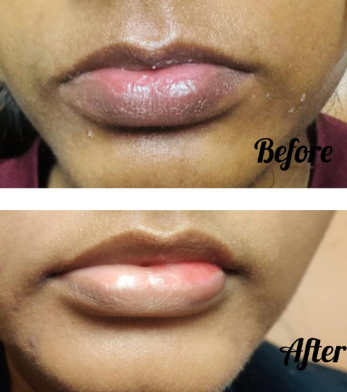 Lip Lightening Before After Result 1 - Mumbai Aesthetics Clinic