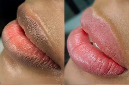 Lip Lightening Before After Result 2 - Mumbai Aesthetics Clinic