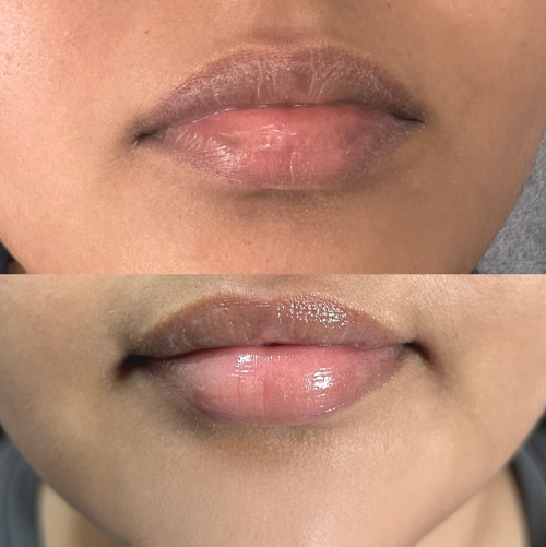 Lip Lightening Before After Result 3 - Mumbai Aesthetics Clinic