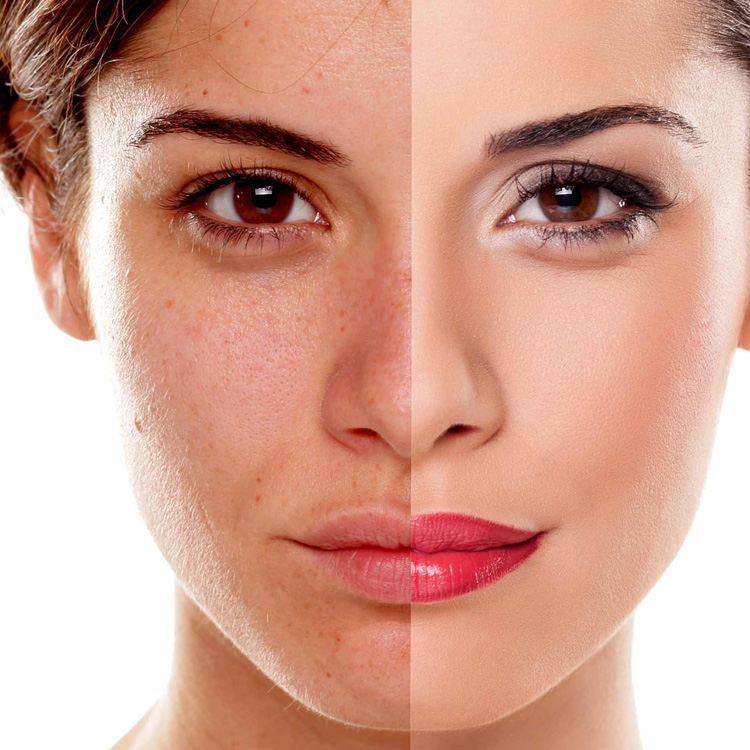 Skin Pigmentation Treatment